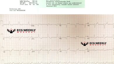 septal infarct